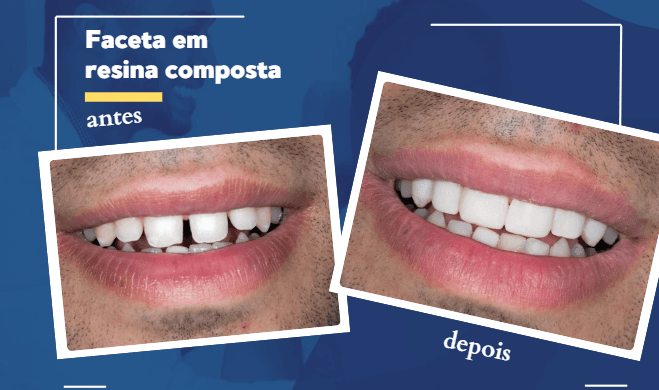 Facetas dentárias em Imperatriz: por que o tratamento virou opção para transformar o sorriso