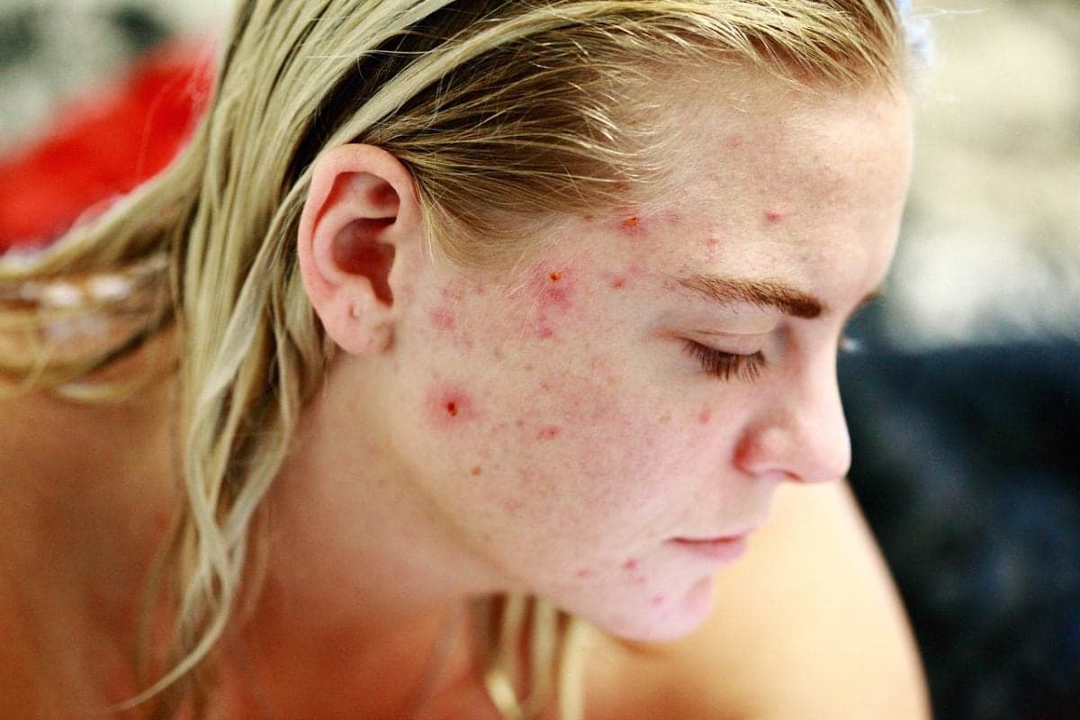 Pesquisas avançam em vacinas para tratamento da acne