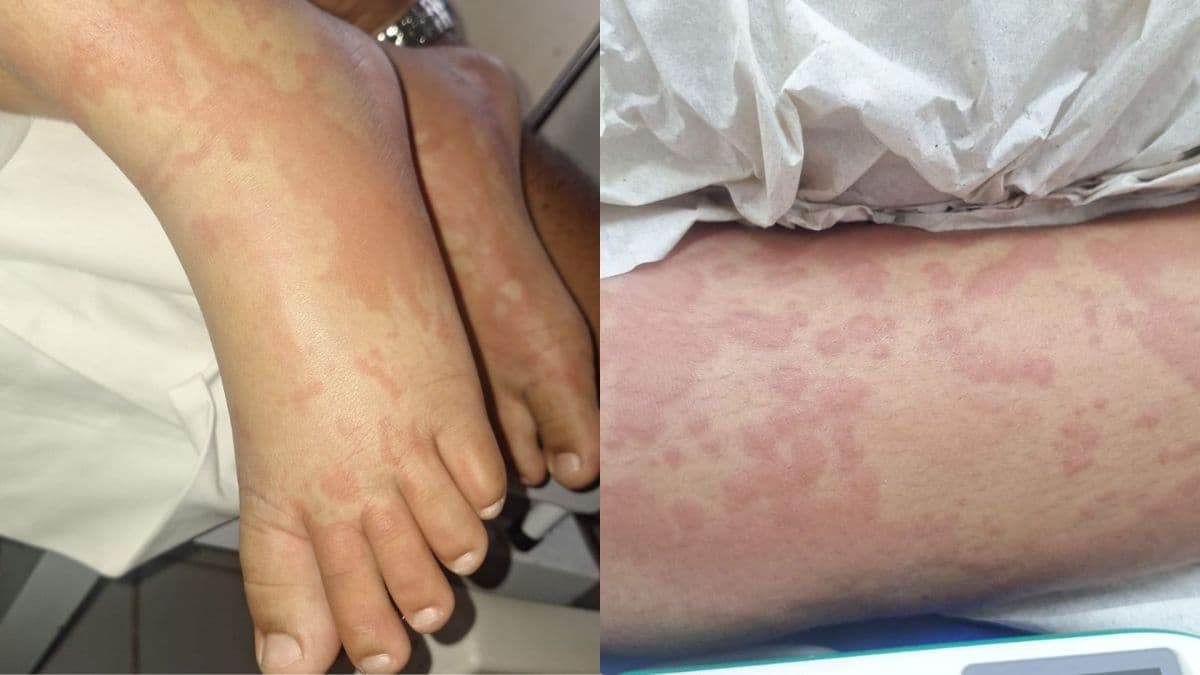 Criança no RN apresenta eritema infeccioso sem ligação com detergente