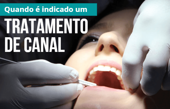 Tratamento de canal em Imperatriz: saiba quando é necessário e onde procurar atendimento