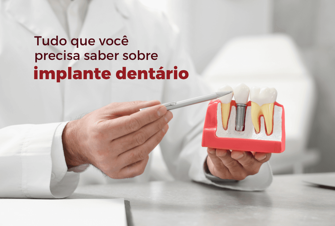 Implantes dentários modernos ampliam opções para recuperar o sorriso em Imperatriz