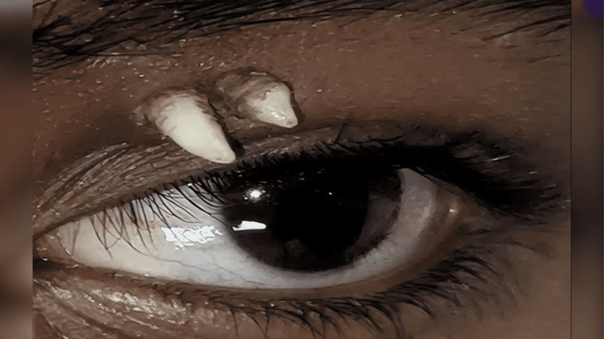 Médicos relatam primeiro caso de dente ectópico na cavidade ocular