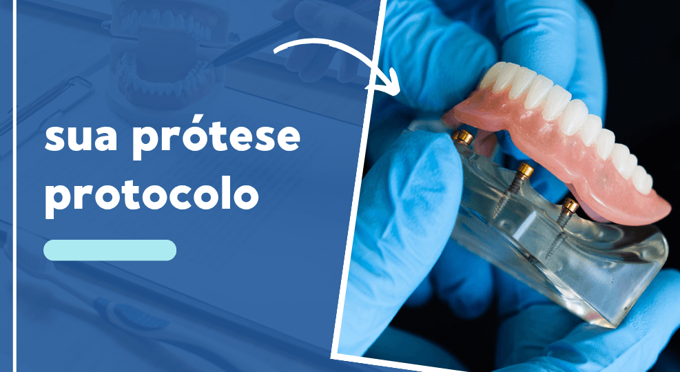 Prótese protocolo em Imperatriz: como funciona e quem pode fazer