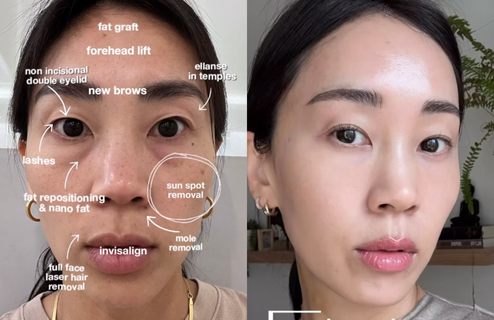 Sara Yoon revela cuidados de pele com tratamento inovador